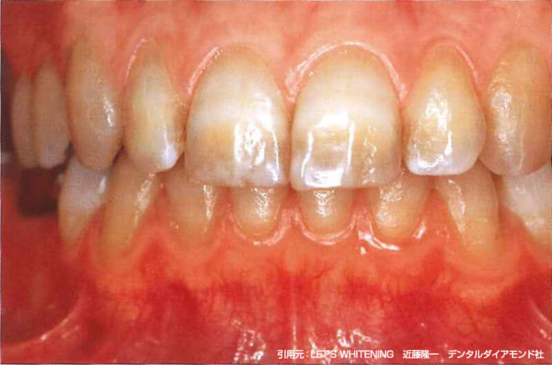 テトラサイクリン歯の特徴と種類 ホワイトエッセンス