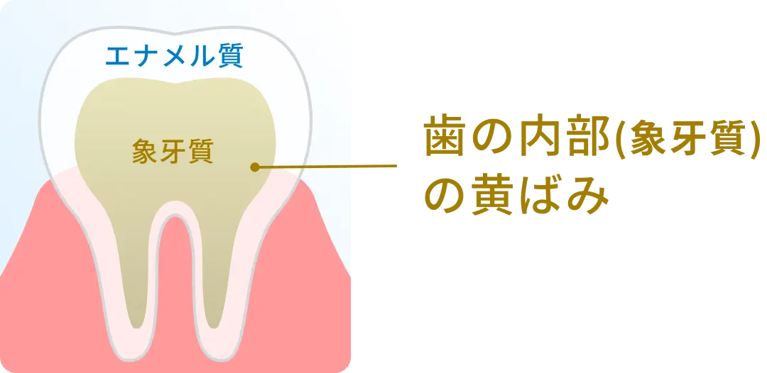 歯の内部(象牙質)の黄ばみイメージ