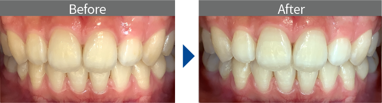 オフィスホワイトニングの症例画像