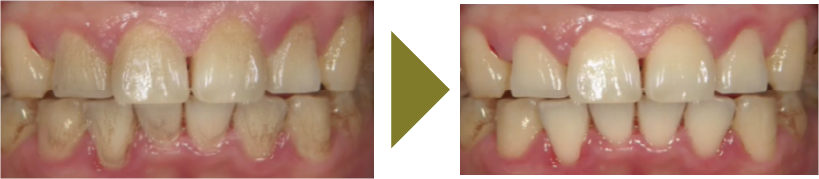 セルフホワイトニングで目指せる歯の白さ