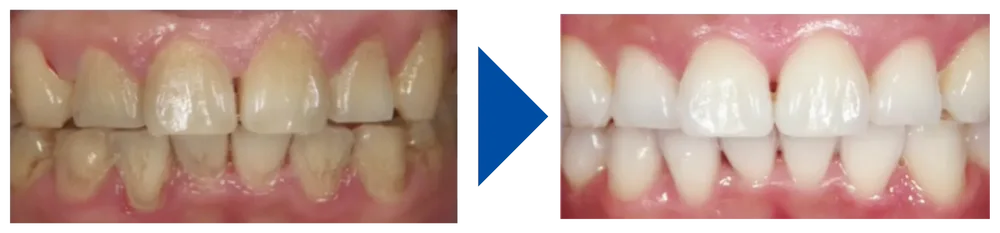 歯科医院のホワイトニングで目指せる白さ