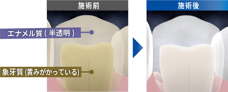 歯の色の比較画像