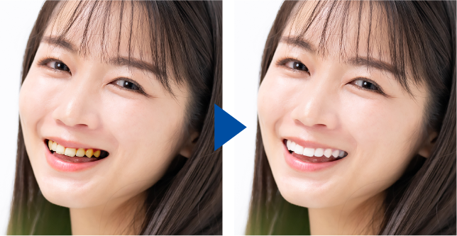 ホワイトニング施術前のイメージ画像