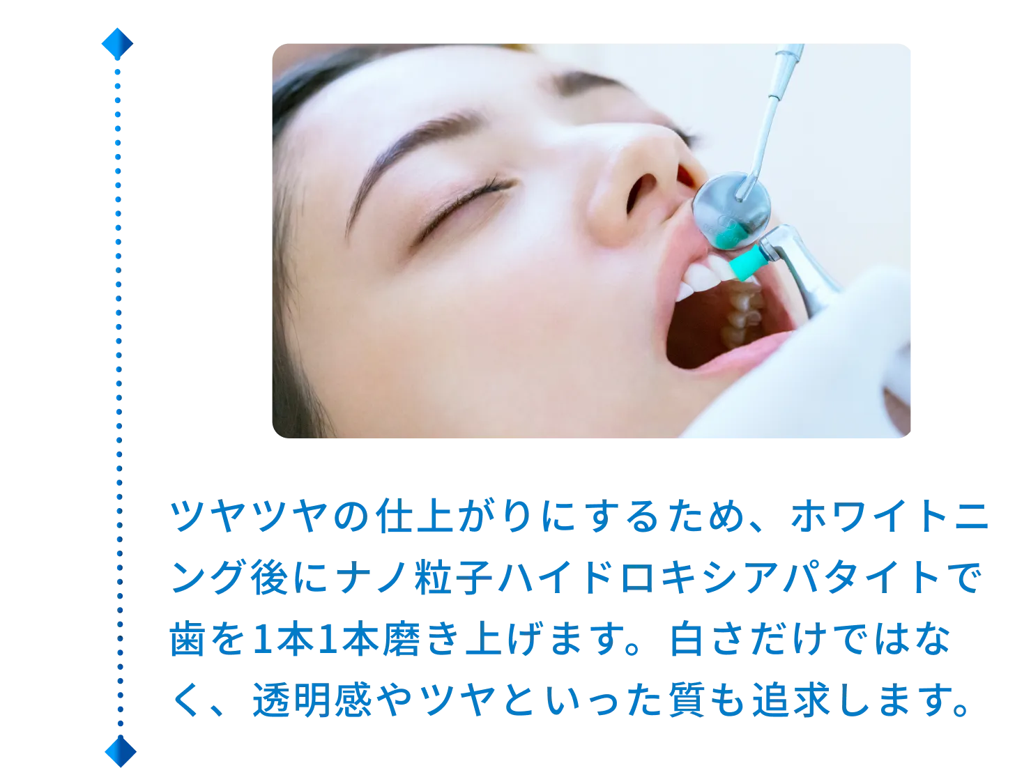 ツヤツヤの仕上がりにするため、ホワイトニング後にナノ粒子ハイドロキシアパタイトで歯を1本1本磨き上げます。白さだけではなく、透明感やツヤといった質も追求します。