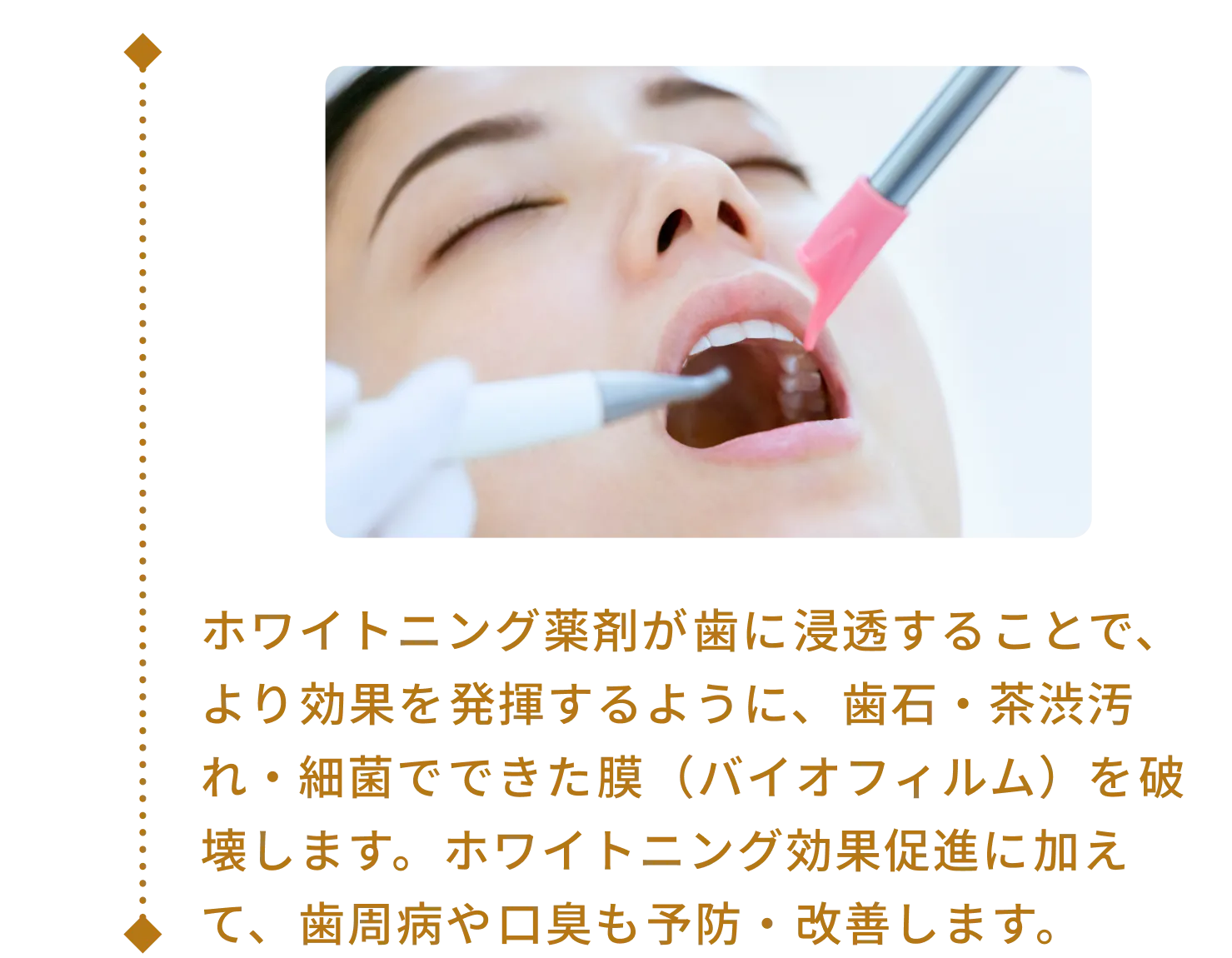 ホワイトニング薬剤が歯に浸透することで、より効果を発揮するように、歯石・茶渋汚れ・細菌でできた膜（バイオフィルム）を破壊します。ホワイトニング効果促進に加えて、歯周病や口臭も予防・改善します。