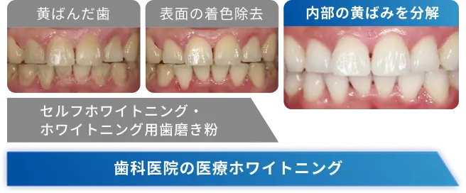 歯科医院の医療ホワイトニングは内部の黄ばみを分解