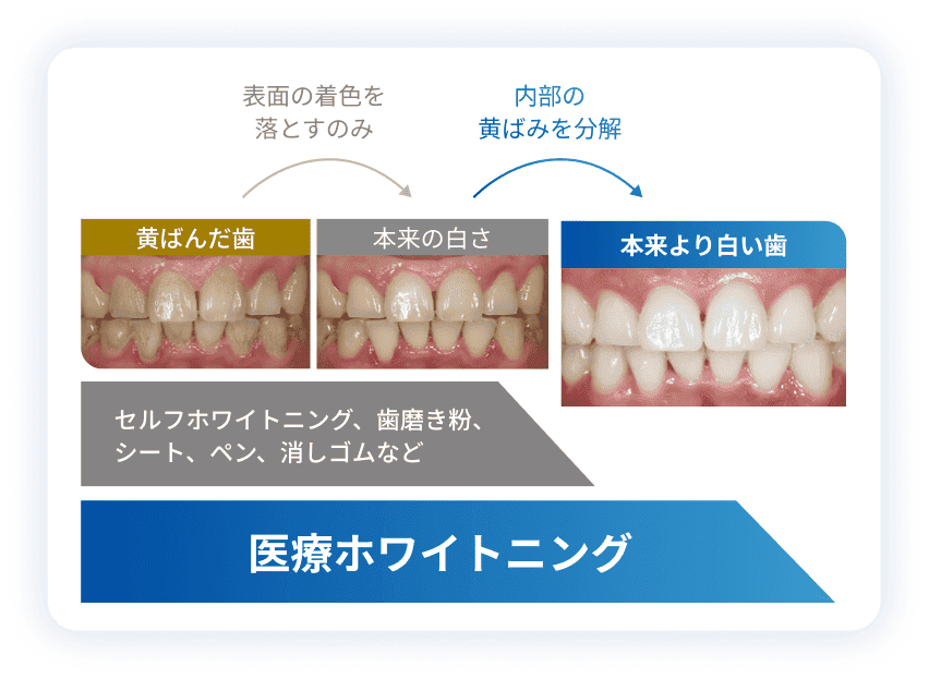 表面の着色落としと内部の黄ばみ分解の違い