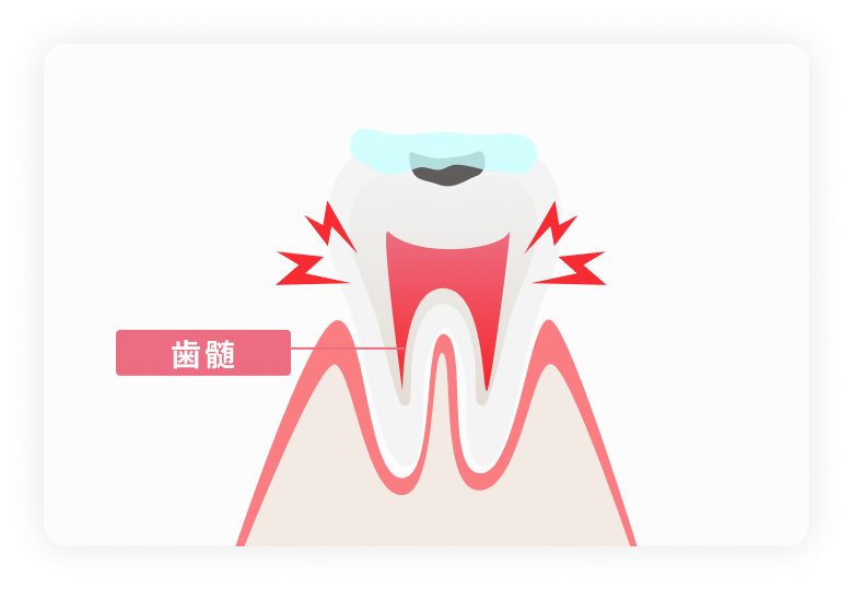 虫歯がある状態のホワイトニングは歯の神経である歯髄に炎症をおこす可能性がある
