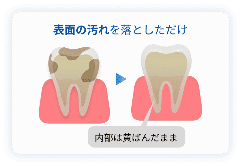 歯の表面の汚れ落とし