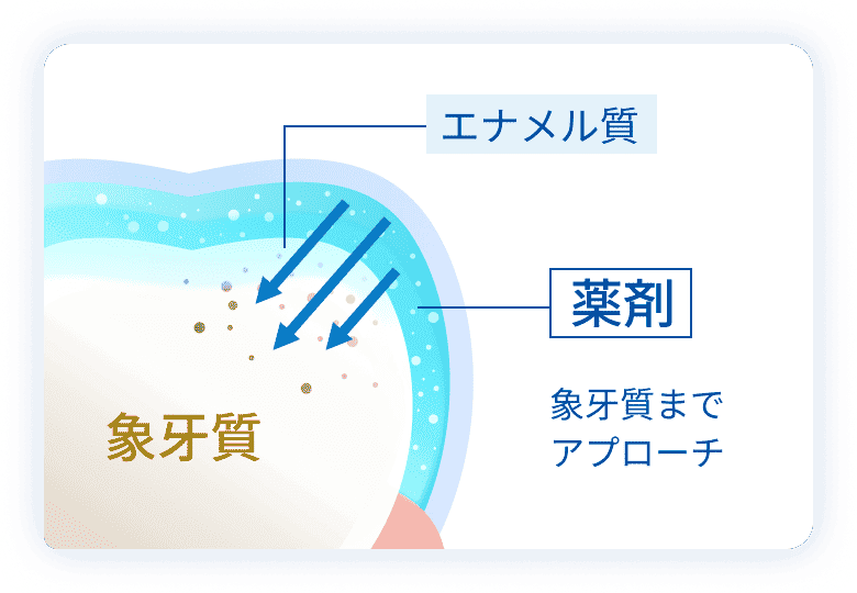 薬剤が象牙質までアプローチ