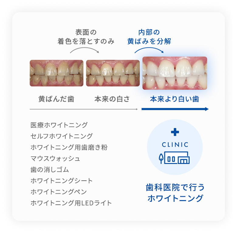 「表面の汚れ止まり」と「歯の内部の黄ばみ分解」の違い