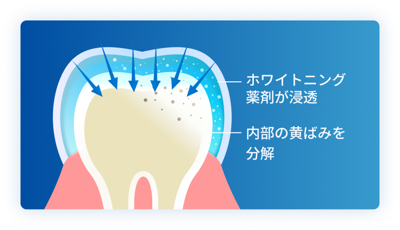 薬剤を歯の内部まで浸透