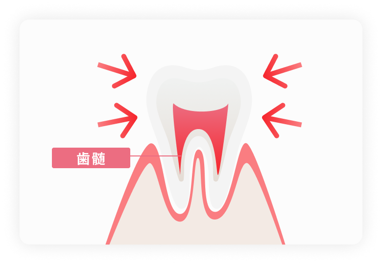 照射器の熱による歯への刺激