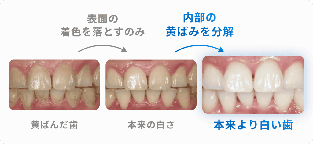 歯の表面の黄ばみを落とす方法と歯の内部の黄ばみを分解する方法の違い