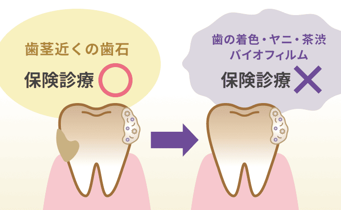 保険診療は歯のヤニ除去が対象外