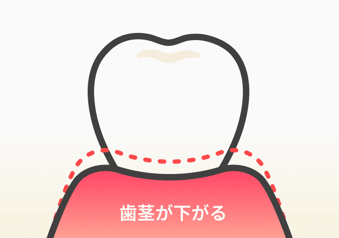 歯間ブラシのやりすぎにより、歯茎が下がるリスク