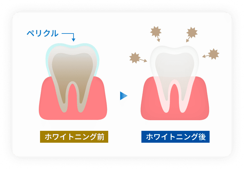 ペリクルが剝がれると着色がつきやすくなり、色戻りの原因に。