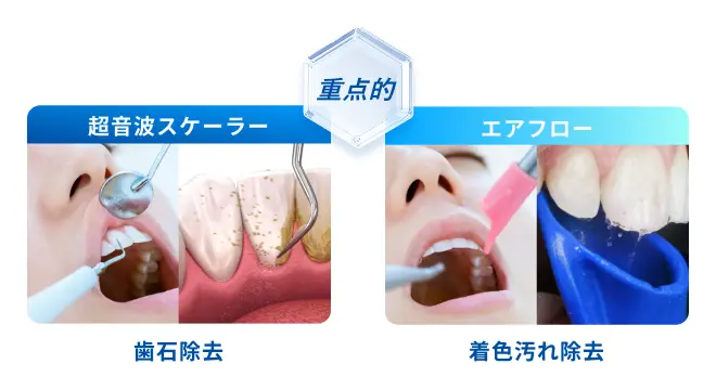 「歯石除去」、「着色汚れ除去」を重点的に
