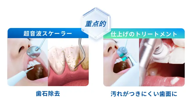 「歯石除去」、「汚れがつきにくい歯面に」を重点的に
