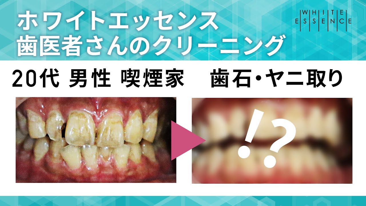ニーズに合わせた歯のクリーニング ホワイトエッセンス ニーズに合わせた歯のクリーニング ホワイトエッセンス