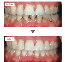 歯のクリーニングの症例写真