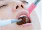 歯のクリーニング工程の着色取りの画像