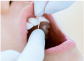 歯のクリーニング工程のフロッシングの画像