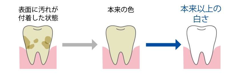 歯のクリーニングで目指せる白さ