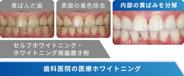 ホワイトニングの症例写真