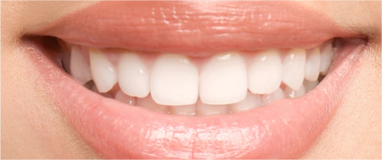 医療のホワイトニングで白くした歯の画像