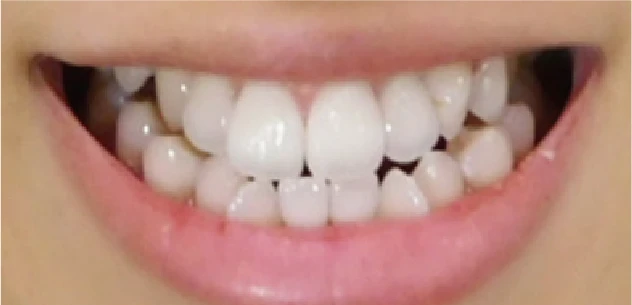 施術後に白くなった歯のイメージ