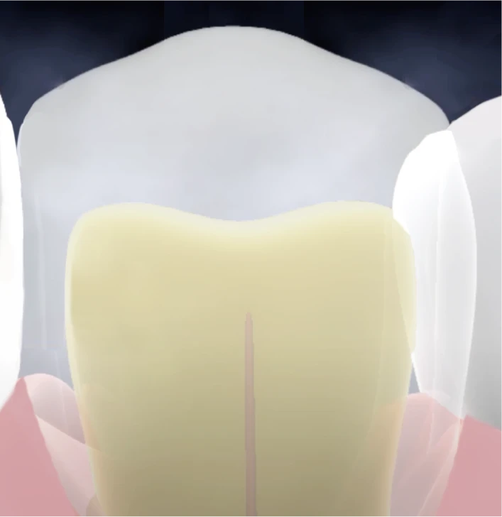 歯の構造（エナメル質と象牙質）