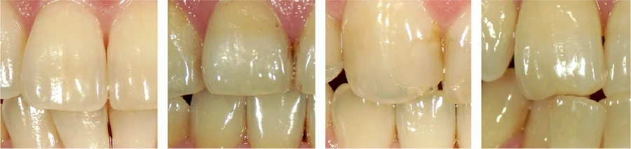 日本人の平均的な歯の白さ