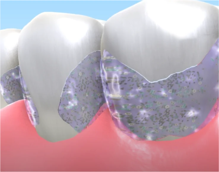 歯の表面の汚れが歯を白くする効果を妨げる