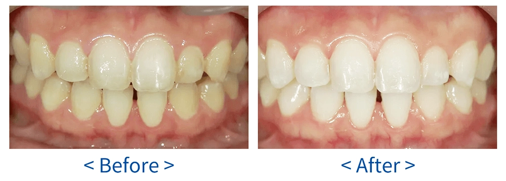 デュアルホワイトニングの20代女性の症例写真