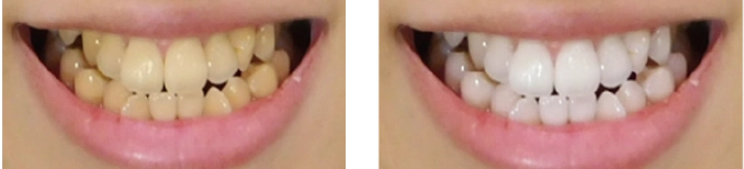 歯が白いと歯の凹凸が目立たなくなるため歯並びが良くみられるようになります