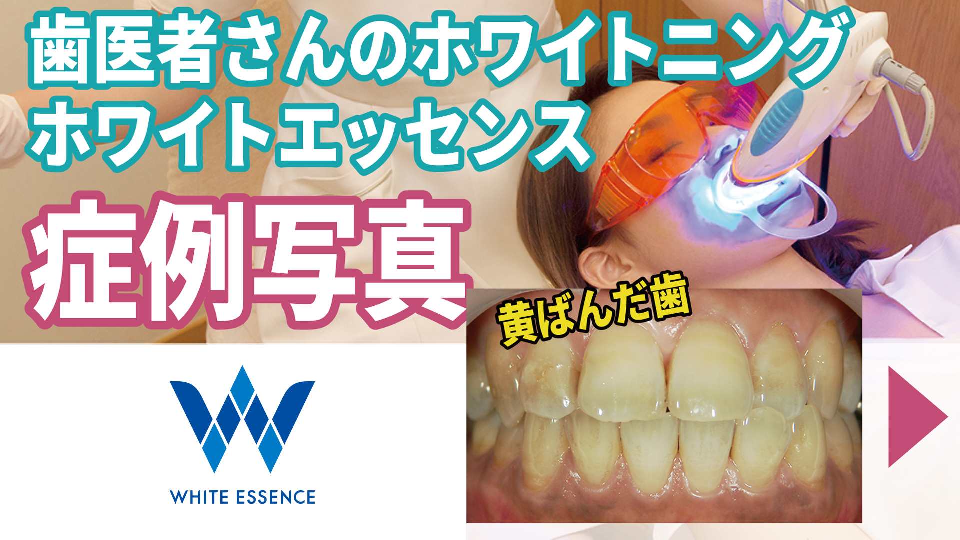 歯医者さんのホワイトニングってどれくらい効果あるの？　症例写真をご紹介【ホワイトエッセンス公式】