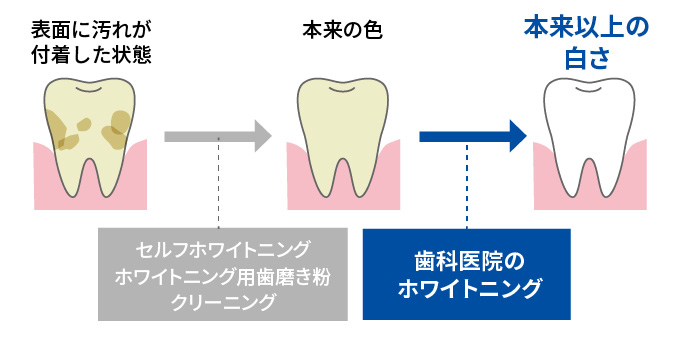 表面に汚れが付着した状態→ホワイトニング用歯磨き粉セルフホワイトニングクリーニング→本来の色→歯科医院のホワイトニング→本来以上の白さ