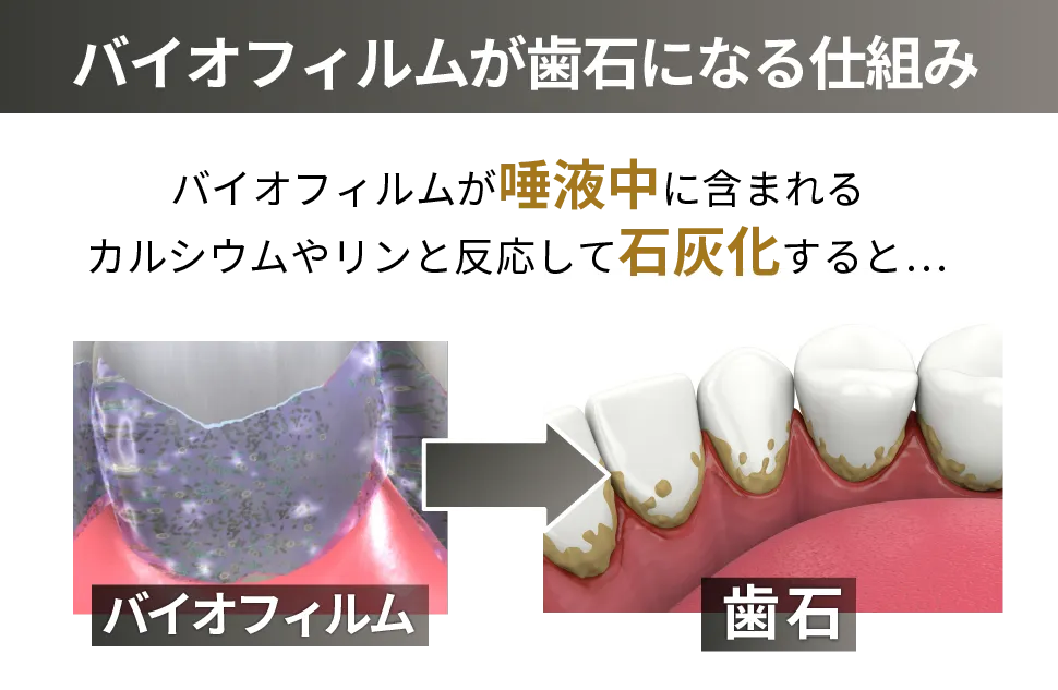 バイオフィルムが歯石になる仕組み
