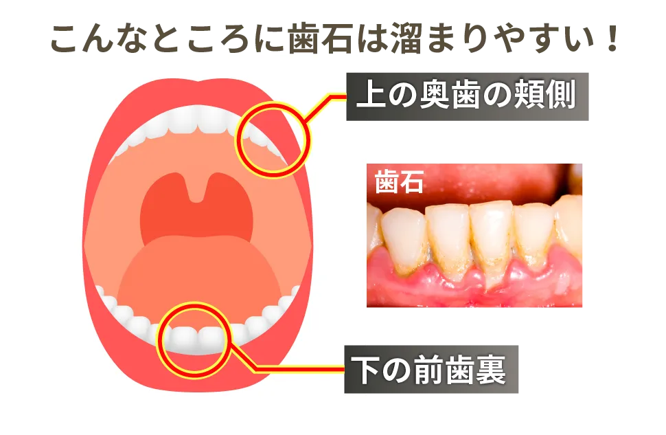 歯石がたまりやすい場所を説明した画像