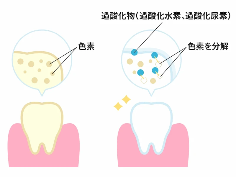 過酸化物の効果により歯の色素を分解