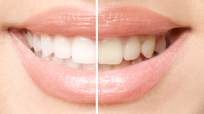 歯の色の比較