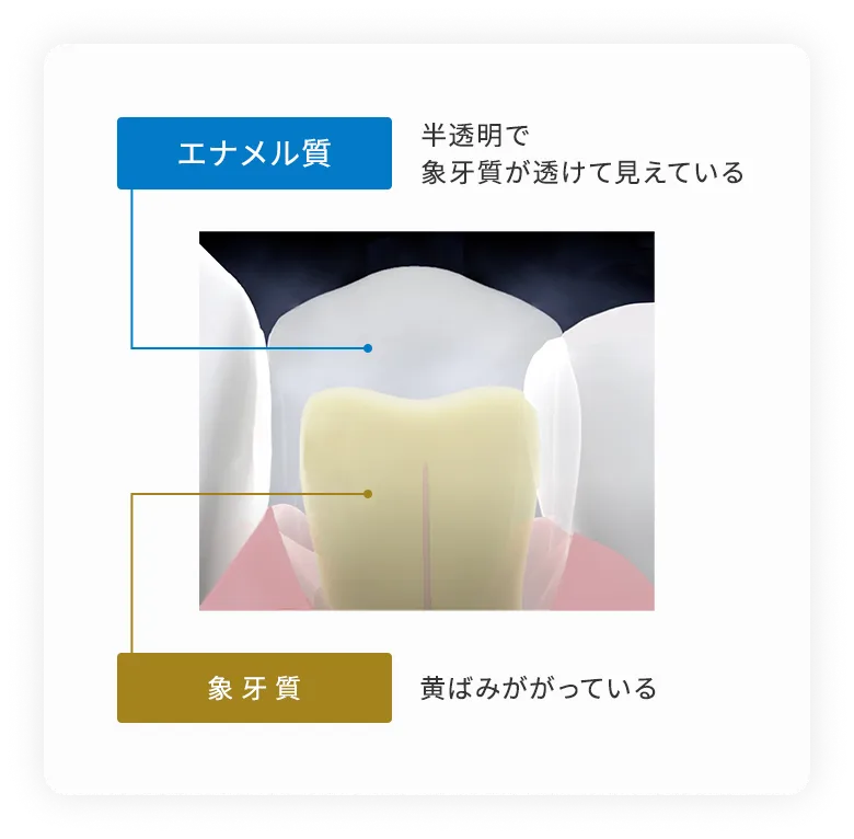 エナメル質　象牙質