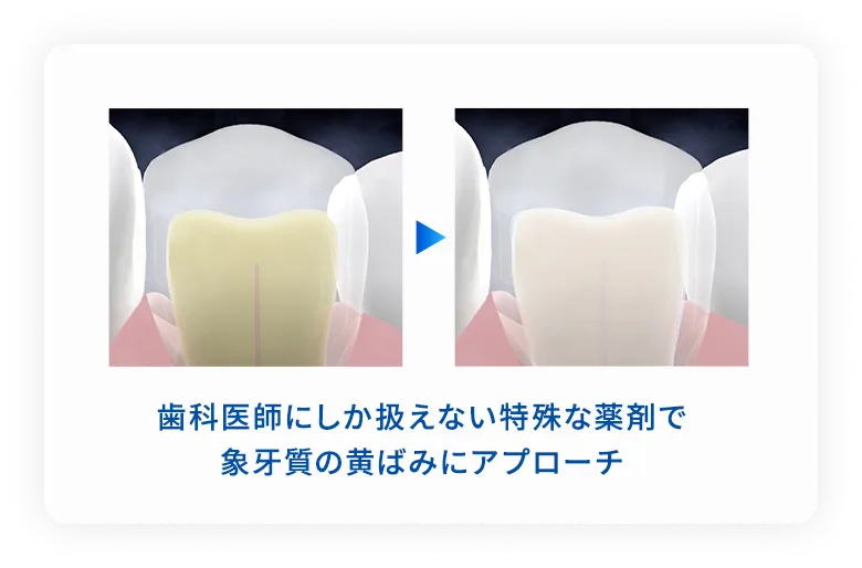 エナメル質　象牙質